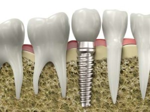 Dental Implant Queens, NY