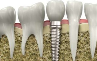 Dental Implant