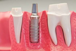 Dental Implants Astoria