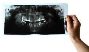 Root Canal in Astoria Queens