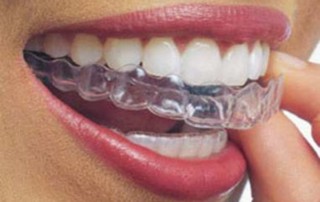 Aligned Teeth Invisalign