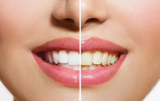 Laser Teeth Whitening 718 Dentist